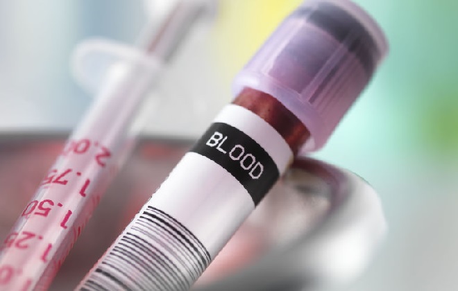Общий анализ крови – подготовка, как сдавать кровь, можно ли есть перед сдачей крови, показатели, таблицы норм у детей и взрослых, расшифровка, цена анализа