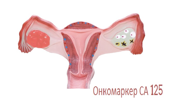 Женская матка и яичники выделяющие онкомаркеры