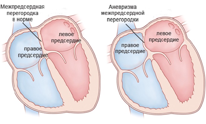 Проявление аневризмы в сердечной перегородке