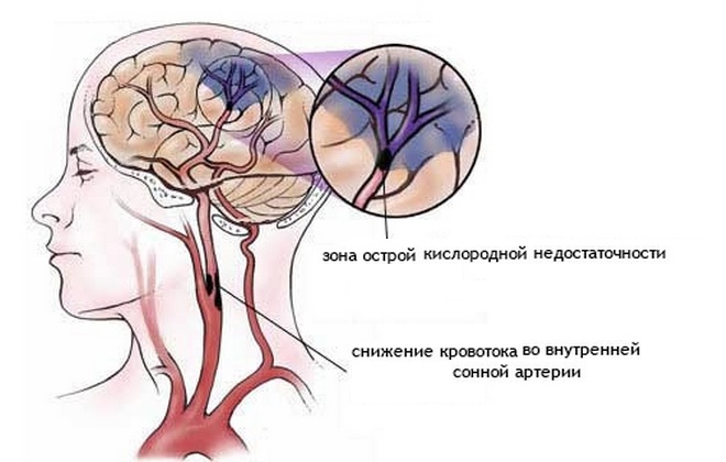 Ишемия головного мозга: что это такое, симптомы, лечение ...