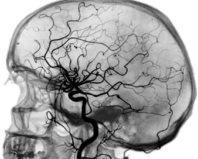 Снимок аэрографии головного мозга человека