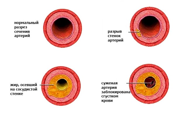 Изображение - Гипертония 3 ст 3 риск srezy-arterij-s-xolesterinom-na-stenkax