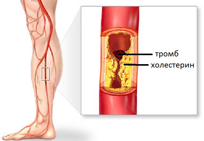 В местах скопления холестерина возрастает риск формирования тромбов