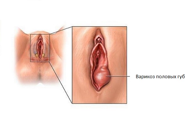 Варикоз половых губ: при беременности в паху, что делать в ...