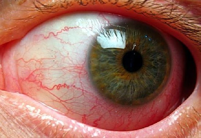 Красный глаз с воспаленными капиллярами