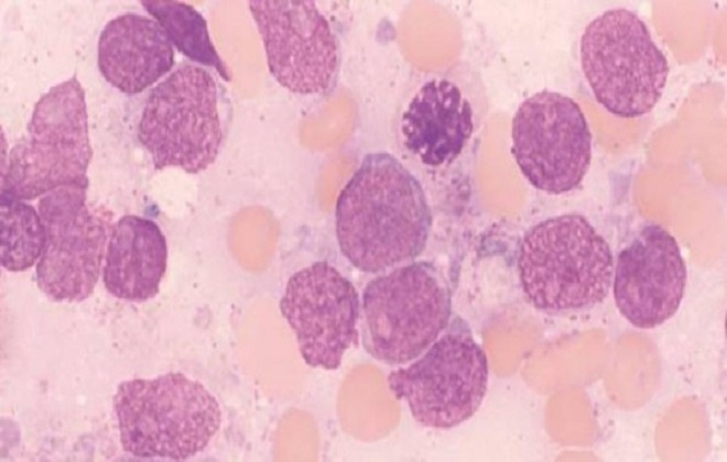 Деформация лейкоцитов при острой форме рака крови
