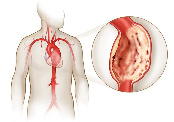 Патология аорты в грудной части