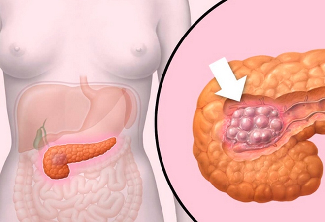 Рак поджелудочной железы 4 стадия: сколько живут?