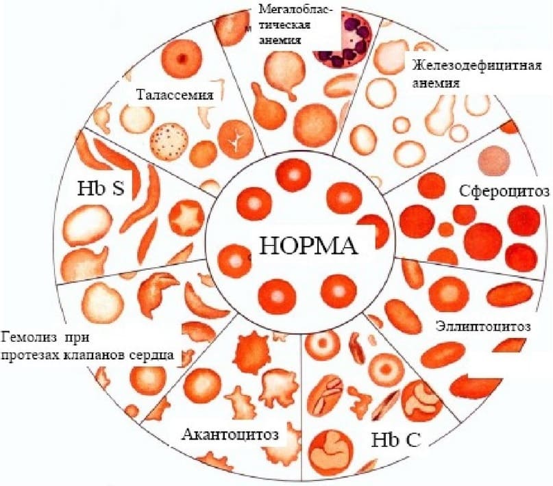 Нормы крови при железодефицитной анемии