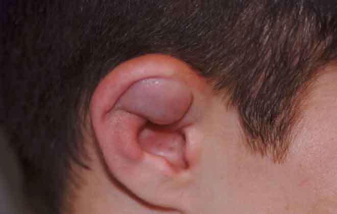 Гематома уха