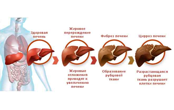 Причины возникновения цирроза